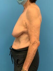 Augmentation-Mastopexy-Case--4504 | Before Breast Augmentation With Lift 2