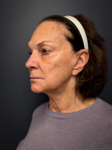 Revision-Facelift-Case--3082 | Before Facelift 2