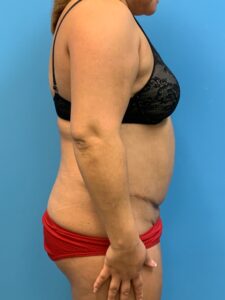 Abdominoplasty-Case--9870 | Before Tummy Tuck 2