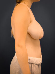 Breast-Reduction-Case--3336 | Before Breast Reduction 2