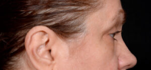 Quad-Blepharoplasty-Case--1851 | Before Eyelid Surgery 1