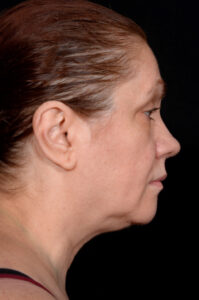 Facelift-Case--6254 | Before Facelift 1