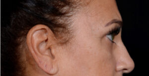 Quad-Blepharoplasty-Case--2302 | Before Eyelid Surgery 2
