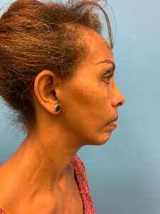 Facelift-Case--1863 | Before Facelift 2