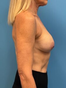 Augmentation-Mastopexy-Case--1505 | Before Breast Augmentation With Lift 2