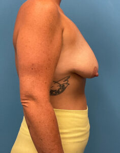 Augmentation-Mastopexy-Case--6355 | Before Breast Lift 2