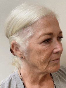 Face-and-Neck-Case--1975 | Before Neck Lift 2