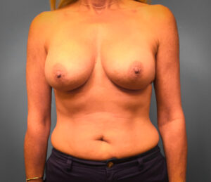 After Breast Augmentation (Front)