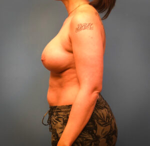 After Breast Augmentation (Side)