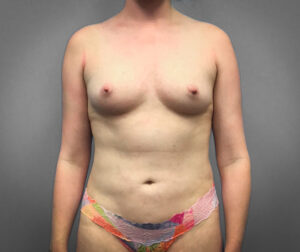 Before Breast Augmentation (Front)