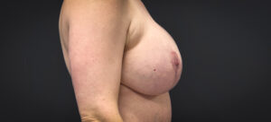 Augmentation-Mastopexy-Case--2453 | After Breast Reconstruction 2