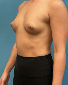 Breast-Augmentation-Case--28179 | Before Breast Augmentation 2