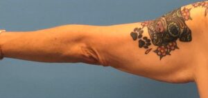 Before photo of patient undergoing an arm lift