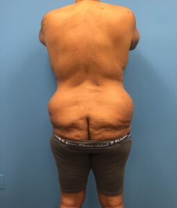 Rearview profile of patient before undergoing a body lift procedure