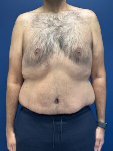 Abdominoplasty-Case--4899 | Before Tummy Tuck 1