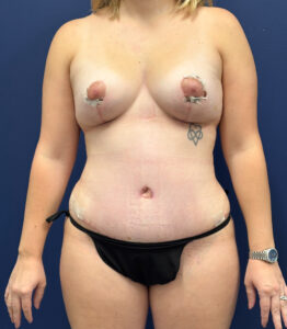 Abdominoplasty-Case--1062 | After Tummy Tuck 1