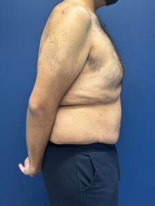 Abdominoplasty-Case--4899 | Before Tummy Tuck 2