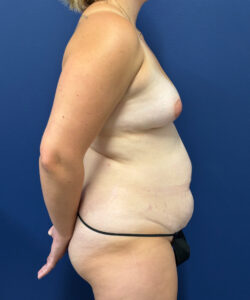 Abdominoplasty-Case--1062 | Before Tummy Tuck 2