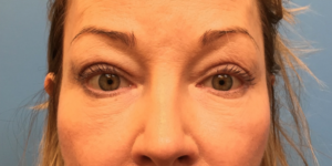 Blepharoplasty-Case--393 | After Eyelid Surgery 1