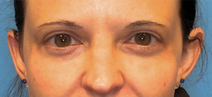 Blepharoplasty-Case--14261 | After Eyelid Surgery 1