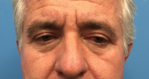 Blepharoplasty-Case--288 | After Eyelid Surgery 1