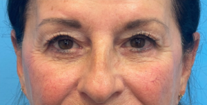 Lower-Blepharoplasty-Case--26440 | After Eyelid Surgery 1