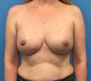 Breast-Reduction-Case--295 | After Breast Reconstruction 1