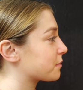 Rhinoplasty-Case--374 | Before Rhinoplasty 1