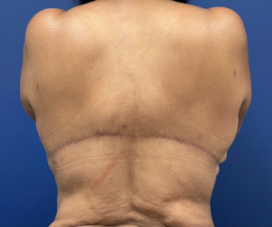 Body-Lift-Case--274 | After Body Lift 1