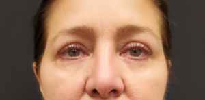 Blepharoplasty-Case--358 | After Eyelid Surgery 2