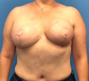 Case--10685 | After Breast Reconstruction 1