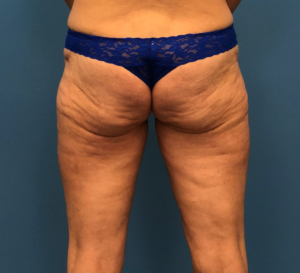 Case--10165 | After Liposuction 1