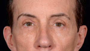 Blepharoplasty-Case--357 | After Eyelid Surgery 2