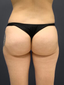 Aveli-Case--1431 | After Dr. Frank Albino 1