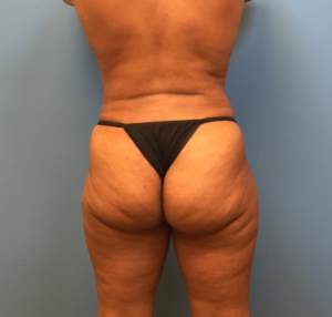 Case--247 | After Liposuction 2