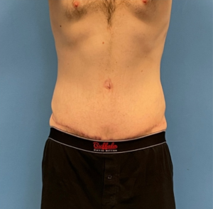 Body-Lift-Case--273 | After Body Lift 1