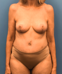 Case--17297 | After Breast Lift 1