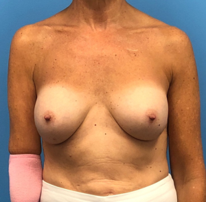 Revision-Augmentation--13287 | After Revision Augmentation 1