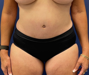 Tummy-Tuck-Case--21804 | After Tummy Tuck 1