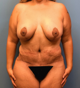 Lipoabdominoplasty-Breast-Augmentation-Case--15133 | After Mommy Makeover 1