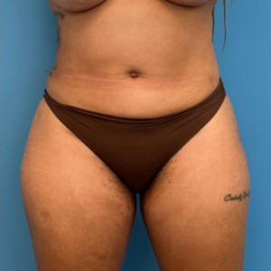 Case--25704 | After Liposuction 1