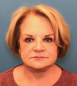 Facelift-Case--14460 | After Facelift 1