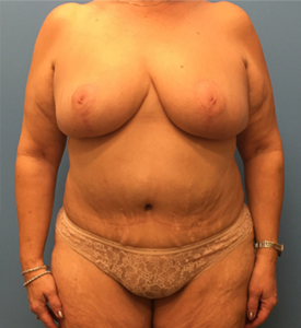 Mommy-Makeover-Case--39 | After Mommy Makeover 1