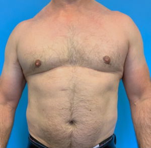 Gynecomastia-Case--20376 | After Gynecomastia / Male Breast Reduction 1