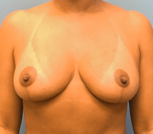 Breast-Reduction-Case--131 | After Breast Reduction 1