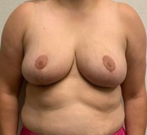Case--26525 | After Breast Reconstruction 1