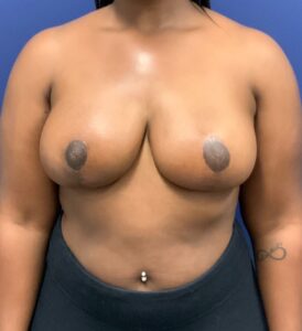 Breast-Reduction-Case--27530 | After Breast Reduction 1
