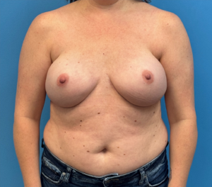 Breast-Reconstruction-Case--27065 | After Breast Reconstruction 1
