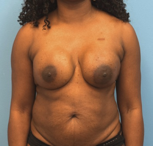 Breast-Reconstruction-Case--23930 | After Breast Reconstruction 1