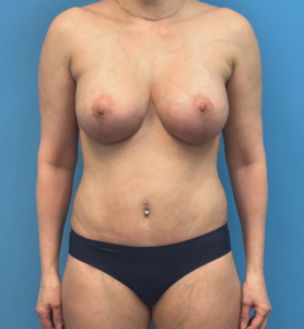 Breast-Augmentation-Tummy-Tuck-Case--28080 | After Body Lift 1